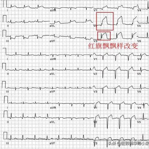 最新心电图速记口诀解析
